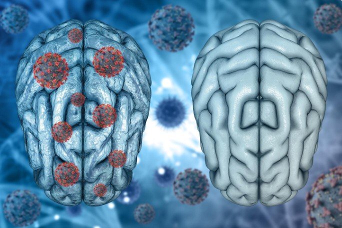 Best Neuro Doctor in India - Dr. Praveen Gupta